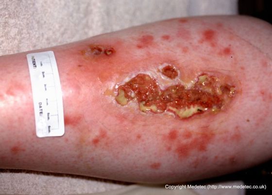 leg ulcer
