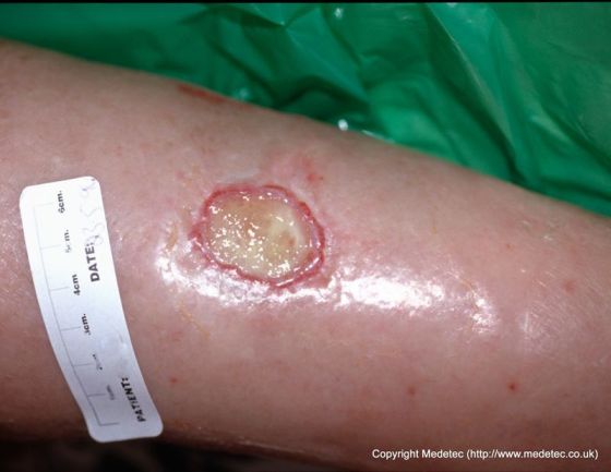 leg ulcer