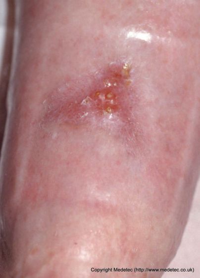 leg ulcer