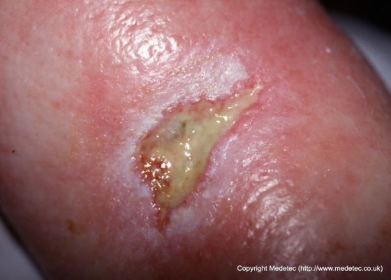 leg ulcer