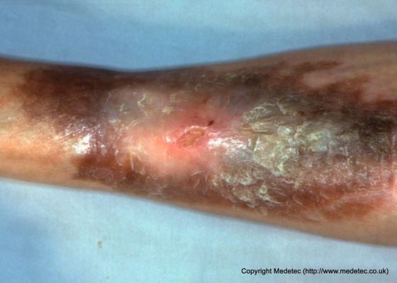 leg ulcer