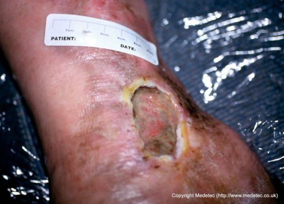 leg ulcer