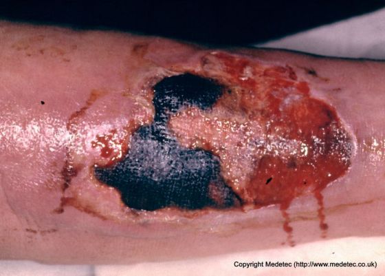 leg ulcer
