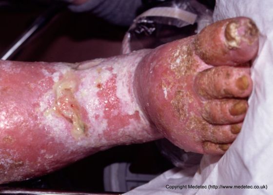 leg ulcer