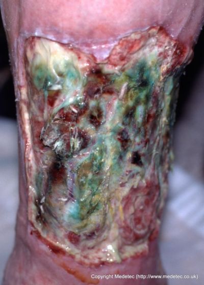 leg ulcer