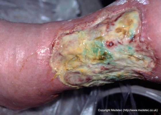 leg ulcer