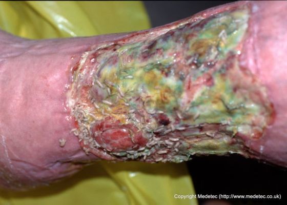 leg ulcer