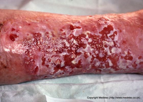 leg ulcer