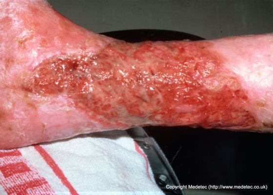 leg ulcer