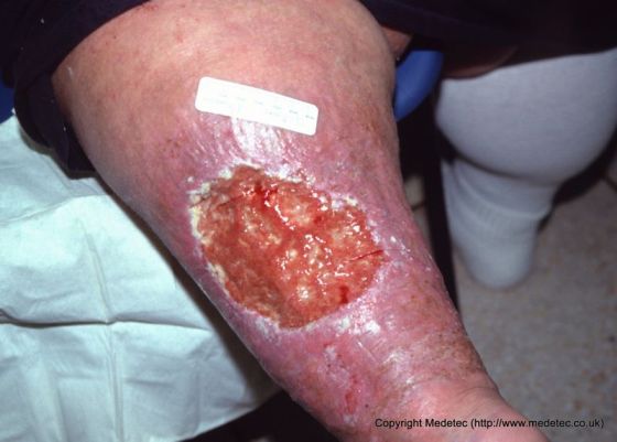 leg ulcer