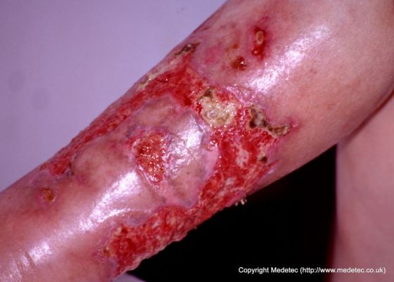 leg ulcer