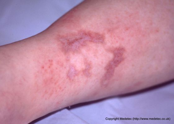 leg ulcer