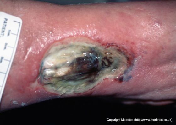 leg ulcer