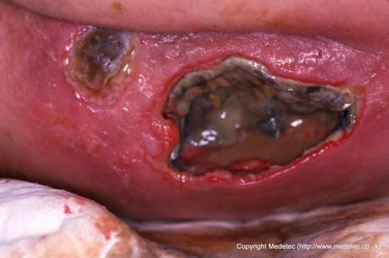 leg ulcer