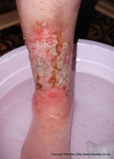 leg ulcer