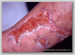 leg ulcer