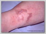 leg ulcer
