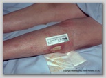 leg ulcer