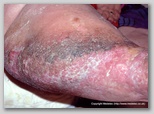 leg ulcer