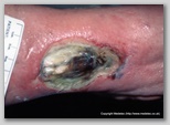 leg ulcer