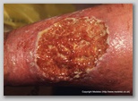 leg ulcer