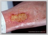 leg ulcer