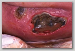 leg ulcer
