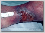 leg ulcer