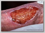 leg ulcer