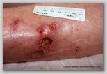leg ulcer