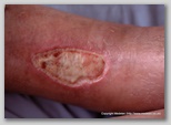leg ulcer