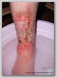 leg ulcer