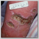 leg ulcer