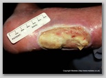 leg ulcer