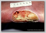leg ulcer