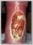 leg ulcer