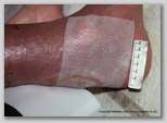 leg ulcer