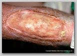 leg ulcer