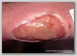 leg ulcer