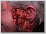 malignant cancerous wound