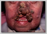 malignant cancerous wound