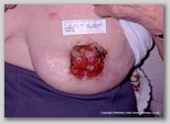 malignant cancerous wound