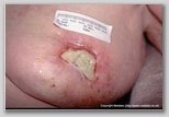 malignant cancerous wound