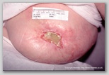 malignant cancerous wound
