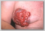malignant cancerous wound