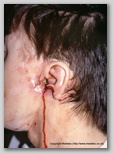 malignant cancerous wound