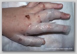 wound image