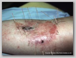 wound image