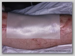 wound image