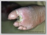wound image